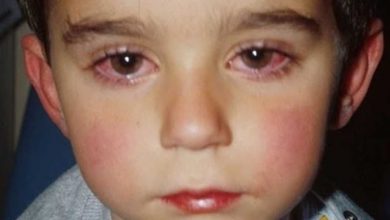 أسباب احمرار العين عند الأطفال وطرق الوقاية منها