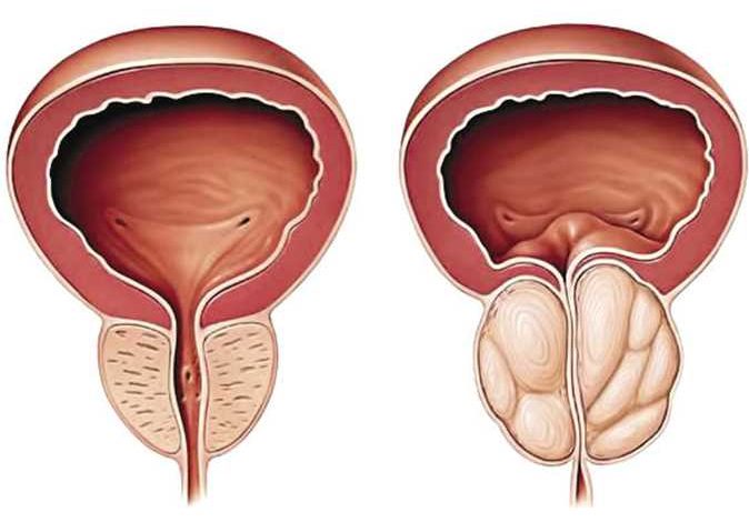 اعراض البروستات لدى الرجال