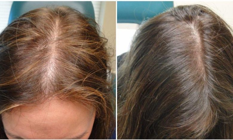 علاج لتساقط الشعر وتكثيفه بطرق منزلية وطبية
