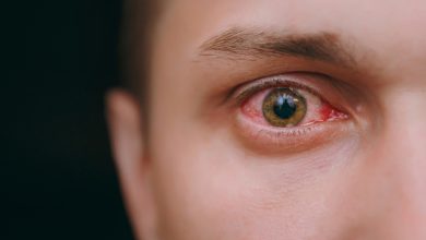 أسباب احمرار العين وطرق تخفيف وعلاج احمرار العين