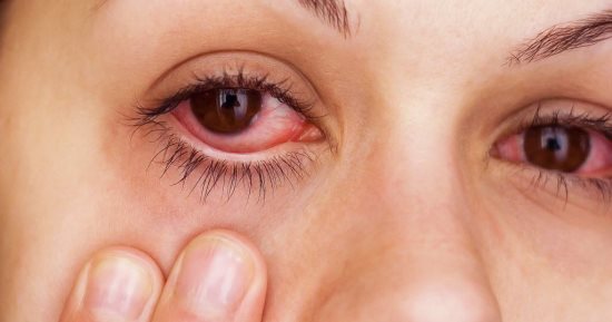 علاجات طبيعية لتخفيف انتفاخ العين بعد البكاء