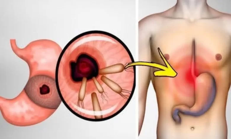 أعراض جرثومة المعدة