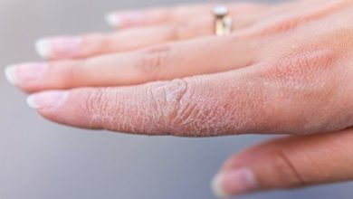 علاج تشقق اليدين من الغسيل