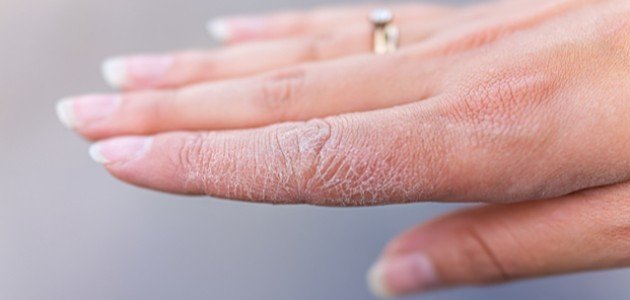 علاج تشقق اليدين من الغسيل