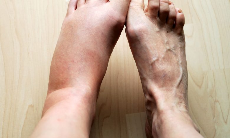 الأسباب الشائعة لتورم القدم بدون ألم وكيفية علاجه