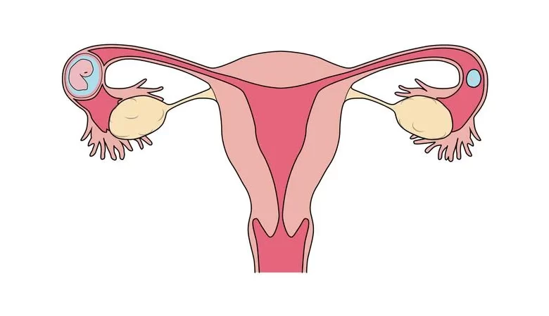 الحمل خارج الرحم عند النساء الأسباب والأعراض وطرق العلاج