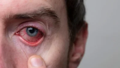 أعراض رمد العين كيف تشخصها وتتعامل معها بفعالية