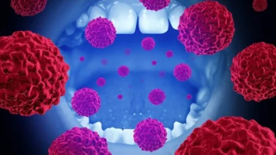 الكشف المبكر عن سرطان الفم أعراض يجب عدم تجاهلها