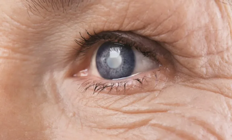 كيفية التعرف على أعراض الماء الأبيض في العين وعلاجها