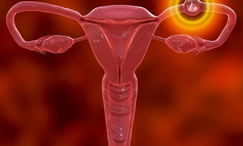 الحمل في قناة فالوب تأثيره على الإنجاب والعلاج الممكن