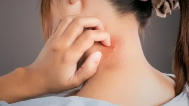 ظهور الحبوب على جسمي مثل لدغة الناموس