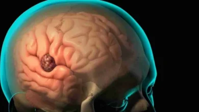 الأعراض الخفية لسرطان الدماغ