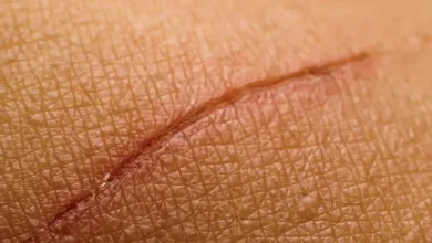 كيفية إزالة آثار الجروح البنية والندوب بطريقة آمنة وفعالة