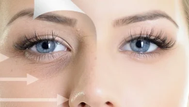 علاج الكدمات السوداء حول العين والأعراض المصاحبة لها