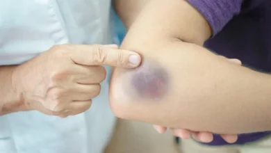 أعراض جلطة الذراع علامات الخطر ومتى تحتاج إلى الطوارئ؟
