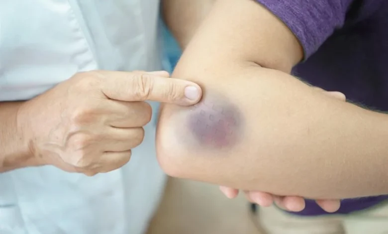 أعراض جلطة الذراع علامات الخطر ومتى تحتاج إلى الطوارئ؟
