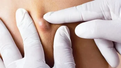 علاج خراج المؤخرة بسرعة