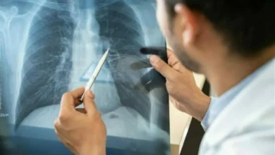 متلازمة الرئة البيضاء عند الأطفال