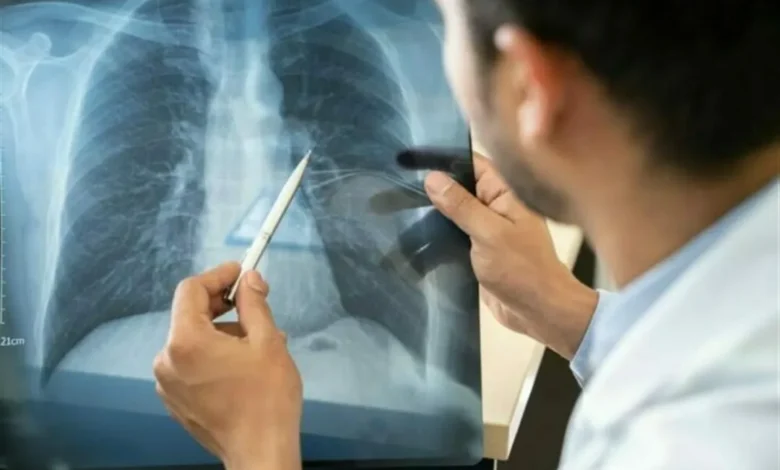 متلازمة الرئة البيضاء عند الأطفال