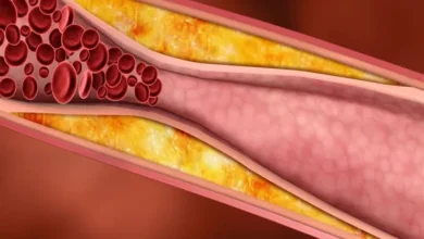أسباب تصلب الشرايين لمرضى السكري وكيفية الوقاية منه؟