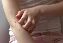 أعراض حساسية الطعام لدى الأطفال وكيفية التعامل معها