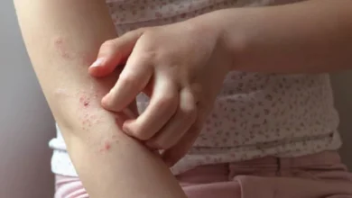 أعراض حساسية الطعام لدى الأطفال وكيفية التعامل معها