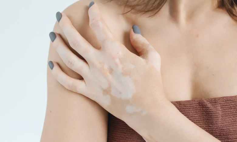كريم أوبزيلورا لعلاج البهاق